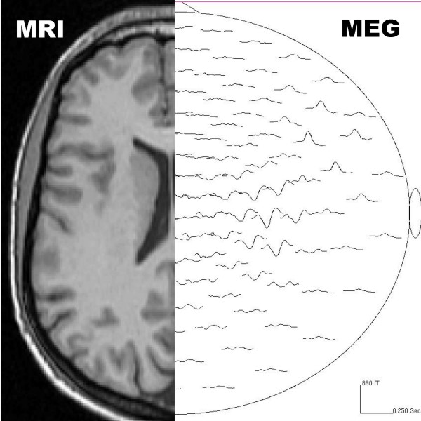 meg imaging